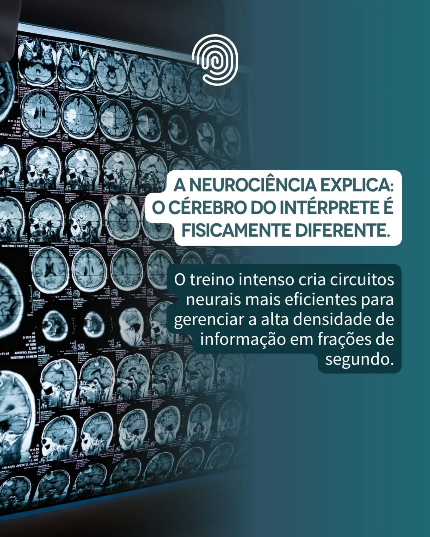 Quem vê um intérprete trabalhando com fluidez na cabine dificilmente imagina a verdadeira "tempestade neuroquímica" que acontece por trás dos fones de ouvido. 

Neurocientistas da Universidade de Genebra, na Suíça, colocaram 50 participantes multilíngues em um aparelho de Ressonância Magnética Funcional e pediram que realizassem três tarefas: ouvir uma frase, repetir uma frase e fazer a interpretação simultânea de uma frase. Os resultados foram surpreendentes. Durante a interpretação, o núcleo caudado, estrutura cerebral profunda responsável pela tomada de decisões e pela coordenação de tarefas complexas, apresentava uma atividade muito mais intensa do que durante a escuta ou a repetição. O núcleo caudado não traduz palavras. Ele atua como um maestro de orquestra, coordenando múltiplas regiões cerebrais em tempo real: ouvir, compreender, reformular, falar e monitorar, tudo simultaneamente. Intérpretes não utilizam apenas mais capacidade cerebral; eles utilizam o cérebro de maneira diferente.

Essa ginástica mental contínua altera a densidade da massa cinzenta em regiões responsáveis pelo controle executivo, pela memória de curto prazo e pelo processamento auditivo. É a prova científica de que a precisão na cabine não nasce do acaso, mas de uma incrível plasticidade cerebral alimentada por anos de estudo, treino e prática profissional. Um estudo separado, realizado com EEG e publicado na revista *PLOS One*, revelou que os cérebros de intérpretes apresentam padrões de conectividade únicos, mesmo em repouso — uma hiperconectividade no lobo frontal que pessoas que não são intérpretes simplesmente não possuem. O cérebro do intérprete não é ativado apenas durante o trabalho; ele é permanentemente reconfigurado pela profissão. 

O resultado? Uma mente treinada para filtrar ruídos, gerenciar o estresse e entregar conexões humanas perfeitas onde antes havia barreiras linguísticas.

fonte: https://speakrllc.com/